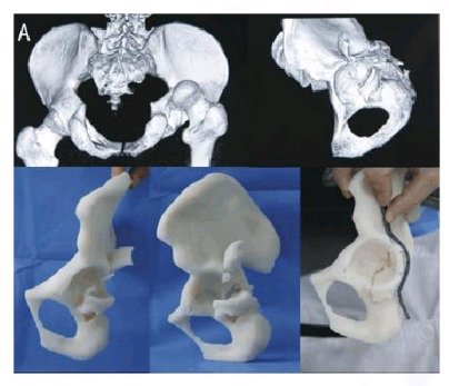 骨科3D打印機應用